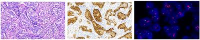 A comparative study of gastric adenocarcinoma HER2 IHC phenotype and mass spectrometry-based quantification